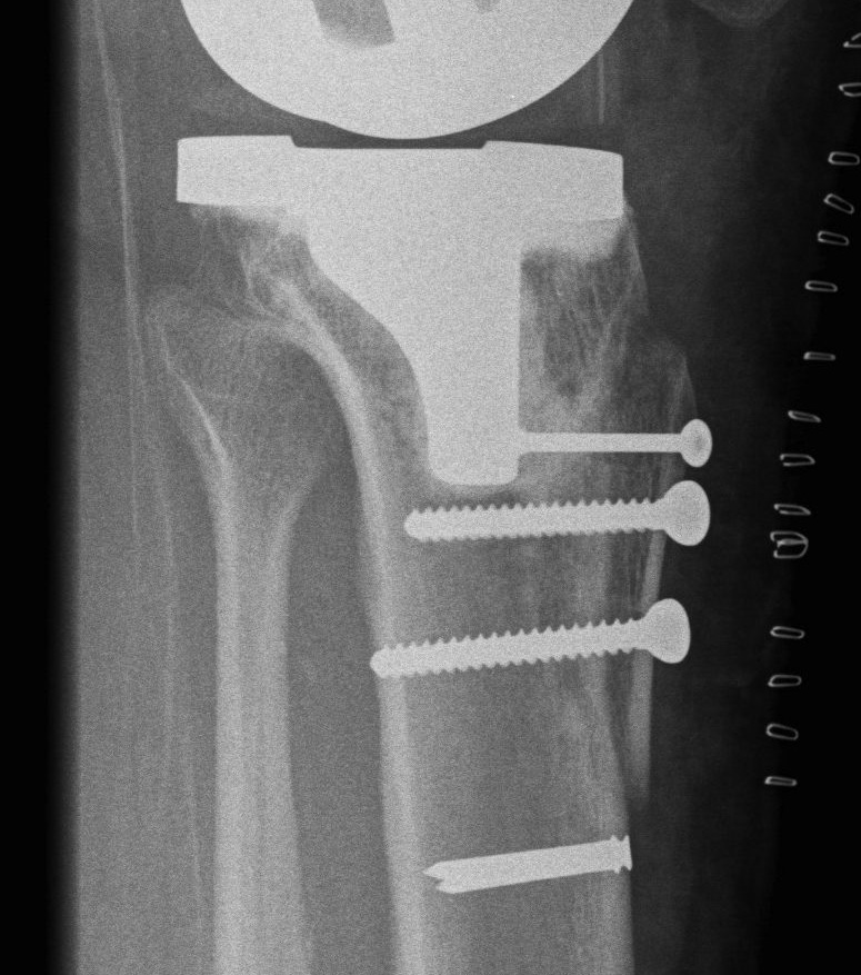 TKR Tibial Tuberosity Transfer Lateral